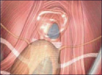 Трансобтураторная коррекция цистоцеле по Palma