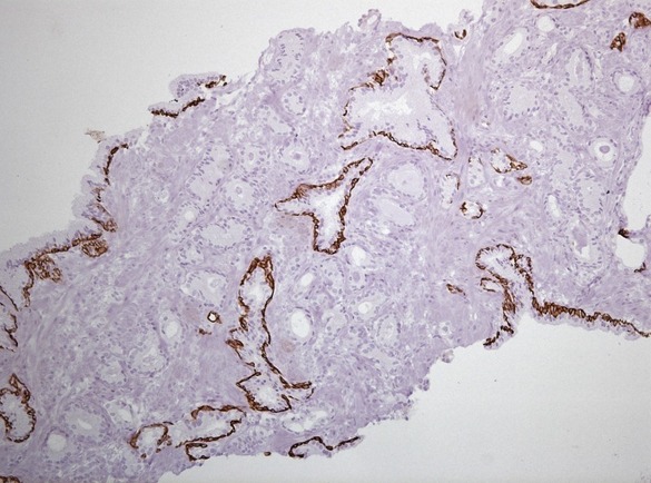 Фокус ацинарной аденокарциномы простаты Глисон 3+3. Окраска ИГХ Cytokeratin HMW